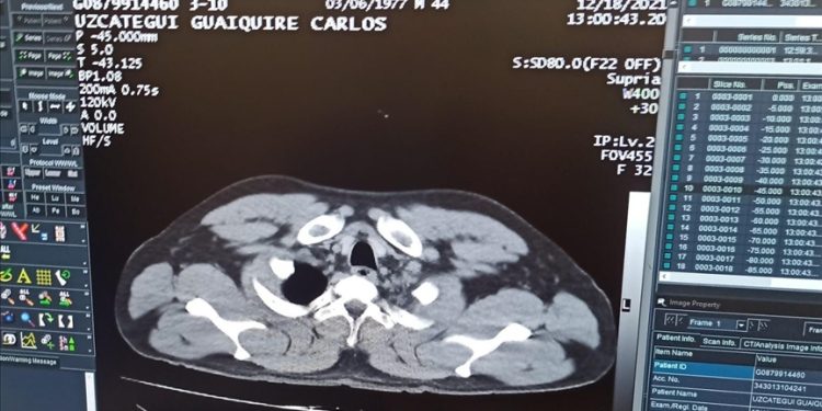 Yolcunun midesinden 12 kapsül kokain çıkarıldı